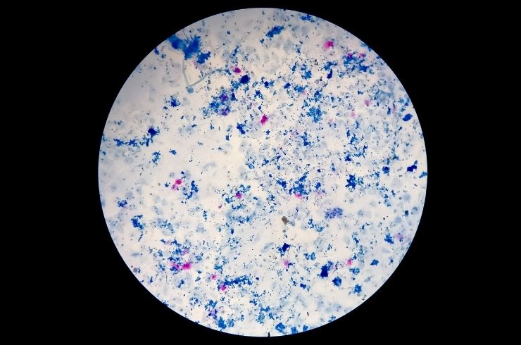 AFB Smear – Sputum