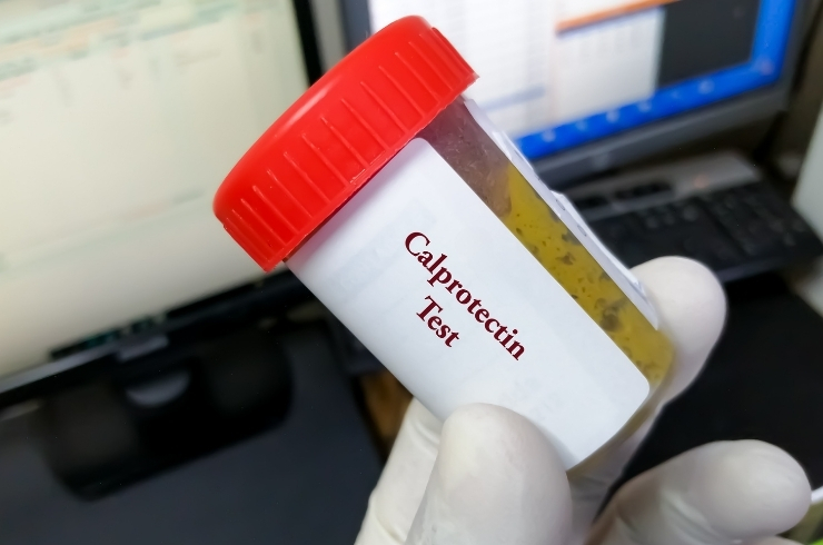 Calprotectin – Stool