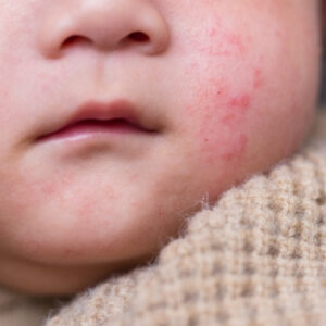 Infant & Child Allergy Panels (ImmunoCAP)