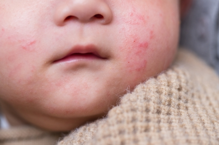 Infant & Child Allergy Panels (ImmunoCAP)