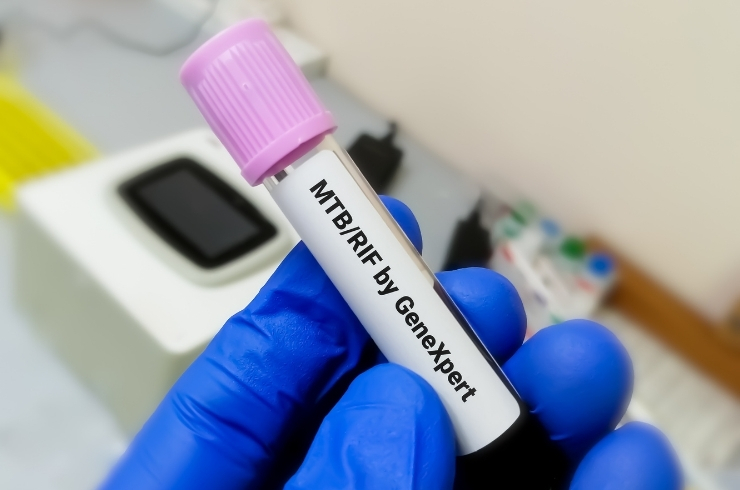 MTB PCR by Gene Xpert