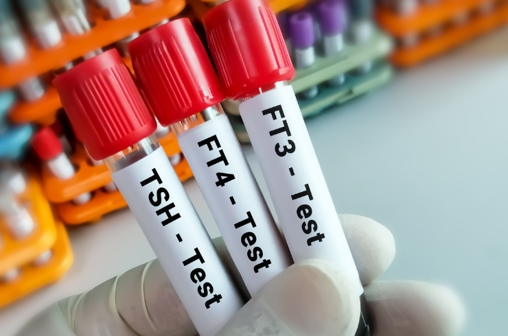 Thyroid Profile (TFT) [T3,T4,TSH]