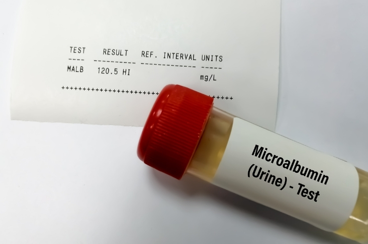 Urine Microalbumin – Spot Sample