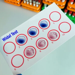 Widal Test – Slide Method