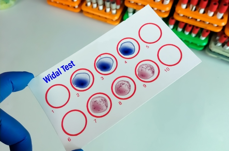 Widal Test – Slide Method
